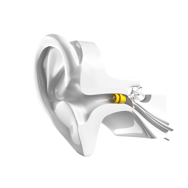 Vista anatomica dell'interno dell'orecchio umano con l'apparecchio acustico Phonak Lyric inserito in profondità nel canale uditivo esterno.