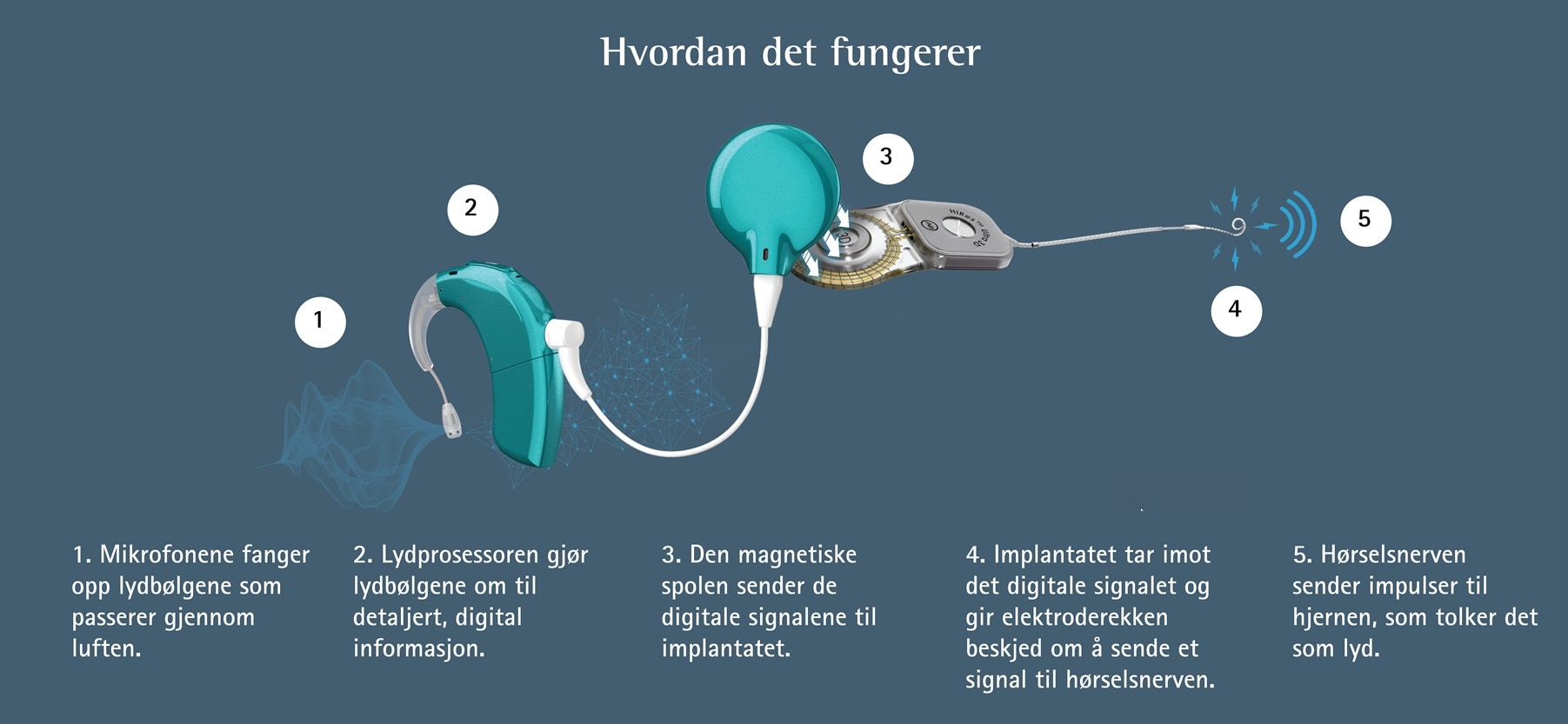 En infografikk med tittelen "Hvordan det fungerer" som illustrerer prosessen med et høreimplantat.